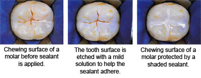 Dental Sealants Dental Sealants